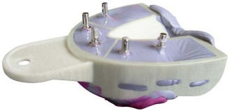 Miratray Implant dolné I2